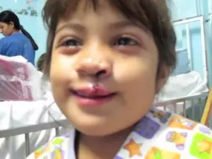 cleft lip surgery cleft lip surgery
